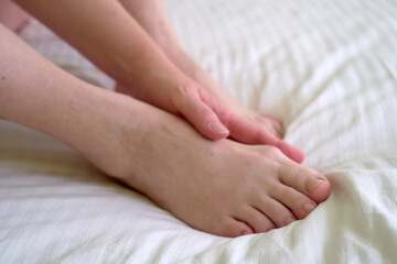 female legs with problem with women's feet, bunion toes in bare feet. Hallus valgus, - obrazy, fototapety, plakaty