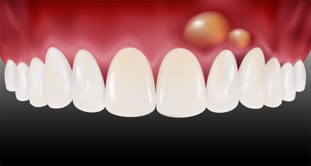 Gingivitis causing swelling and pus Caused by unclean teeth and gums and infection. Realistic vector illustration Isolated on white background.