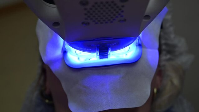 Dental Whitening process in patient mouth. Teeth whitening with UF Lamp, Led Lamp and gel. Dental Extreme Close up Macro Video. Concept of professional dental hygiene. 4k 120 fps slow motion footage
