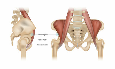 Internal snapping hip Syndrome. Psoas major, Iliopsoas muscle and Snapping area
