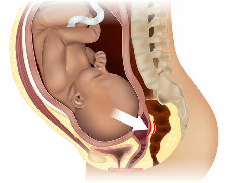 Rectal Pressure During Birth. Pregnancy and Labour.Baby head may put pressure on the nerves in the pelvis and rectum.