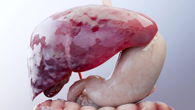 Digestive Organ Liver Cancer, Hepatitis cirrhosis malignant tumor, Hepatic failure, growing cells, duplicating, Fibrosis, Cirrhosis, Hepatocellular carcinoma, Virus infected liver, Human, 3d render