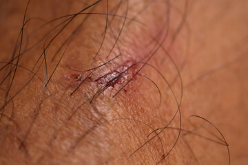 Bleeding wound on human skin. Health care concept