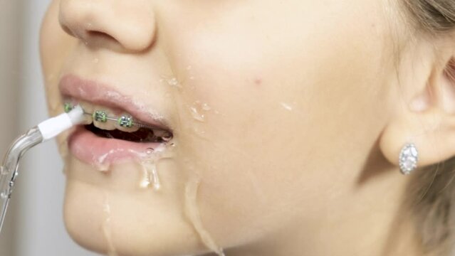 A child cleans braces with water flosser dental irrigator, close up. Orthodontic oral care, treatment, hygiene