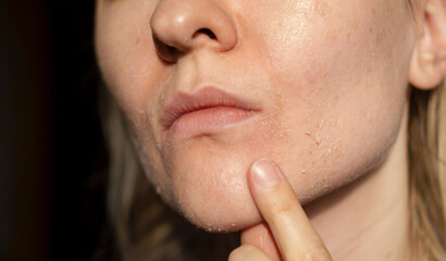 The woman skin flakes off at the mouth. Dry skin. Face skin irritation after peeling, after cold windy weather. Dark background, view by profile. She is showing the problem with the finger. - obrazy, fototapety, plakaty