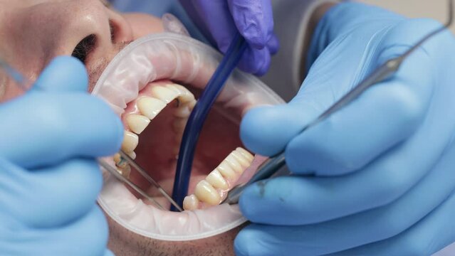 Dental tooth implantation. Dental bone grafting as preparation for dental implant installation. Dental surgery
