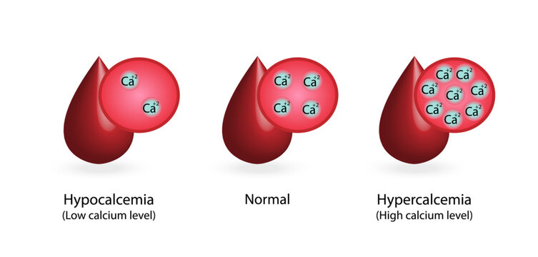 Hypercalcemia, high plasma calcium level and hypocalcemia, low plasma calcium level. Calcium excess and deficit electrolyte disorders, blood droplet, Scientific design. Vector illustration.