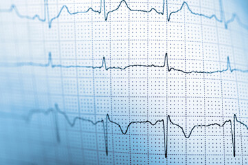 Close-up of an electrocardiogram printed on blue paper.