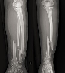 broken hand x ray image 