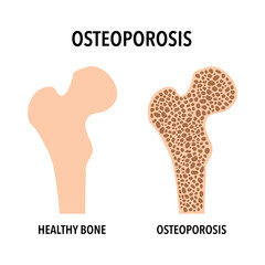 Osteoporosis bone and healthy bone in flat design on white background.