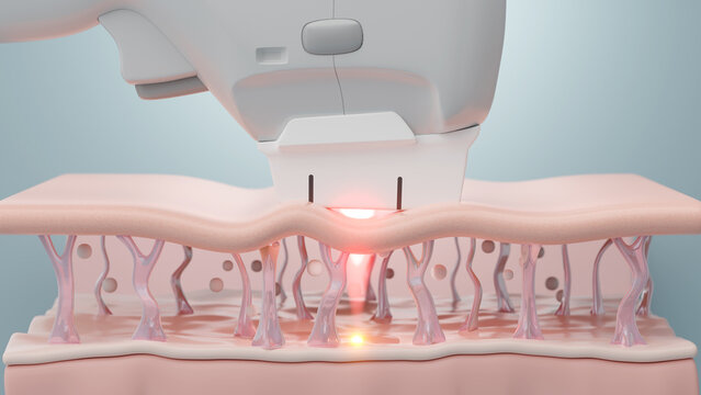 Ultherapy or HIFU treatment shot laser to SMAS to lift and tighten skin, Blue science background. 3D rendering.