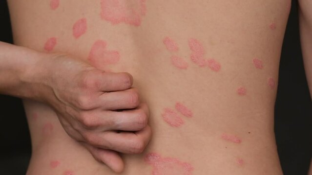 Psoriasis Vulgaris, skin patches are typically red, itchy, and scaly. Papules of chronic psoriasis vulgaris on male hand, back and body. Genetic immune disease. A man scratches his back with his hand