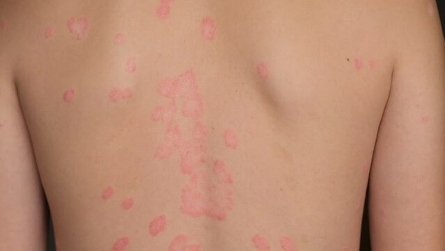 Psoriasis Vulgaris, skin patches are typically red, itchy, and scaly. Papules of chronic psoriasis vulgaris on male hand, back and body. Genetic immune disease. Detail of psoriatic skin disease 