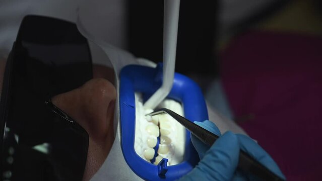 Dental Whitening process in patient mouth. Teeth whitening with UF Lamp, Led Lamp and gel. Dental Extreme Close up Macro Video. Concept of professional dental hygiene. 4k 120 fps slow motion footage