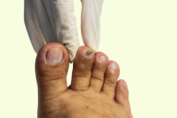 Hematoma formation on the toenail caused by being hit by a hard object.