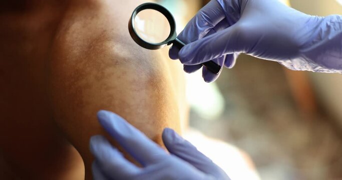 The doctor hands with a magnifying glass above the skin of the shoulder. Sun burn, visit to a dermatologist