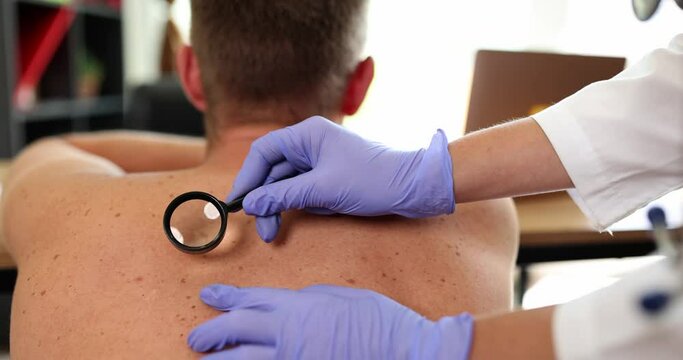 The dermatologist examines the mole on the back with a magnifying glass, close-up, slowmotion. Skin diseases