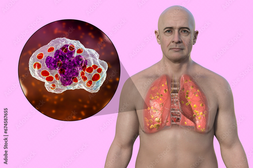 Wall mural Lung histoplasmosis, a fungal infection caused by Histoplasma capsulatum, 3D illustration