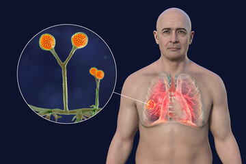 A man with lung mucormycosis lesion, with close-up view of Rhizomucor fungi, 3D illustration