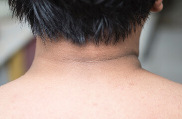 Black stains and wrinkles on the skin around a person's neck