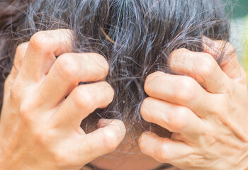 Dandruff, flaky scalp caused by dry skin. Allergy to cosmetics or has fungus