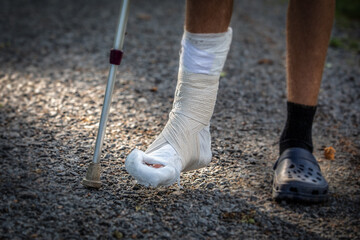 Broken ankle and a leg cast. Leg splint