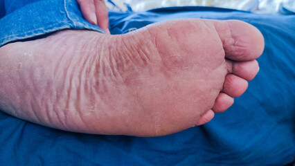 detail of a sore and dry foot awaiting medical treatment from a podiatrist