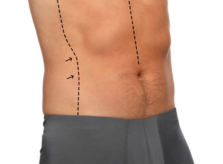 Man with markings for cosmetic surgery on his abdomen against white background, closeup