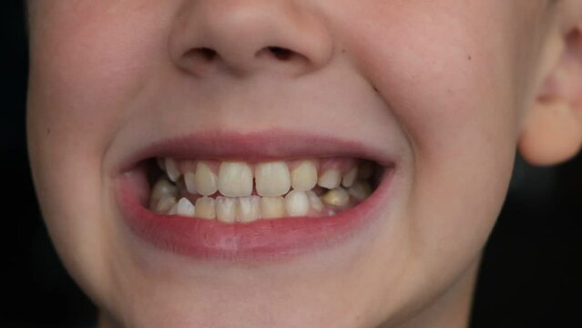 Child's crooked teeth. Young man showing crooked growing teeth. The child needs to go to the dentist to install braces.