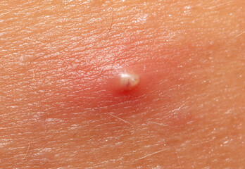 Acne on human skin. Macro