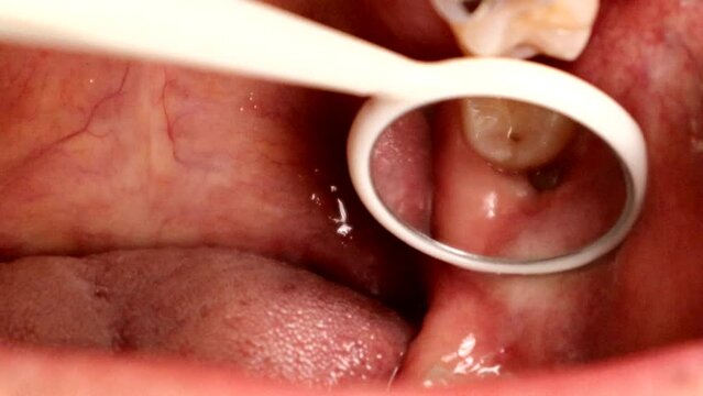 少し生えてきた親知らず