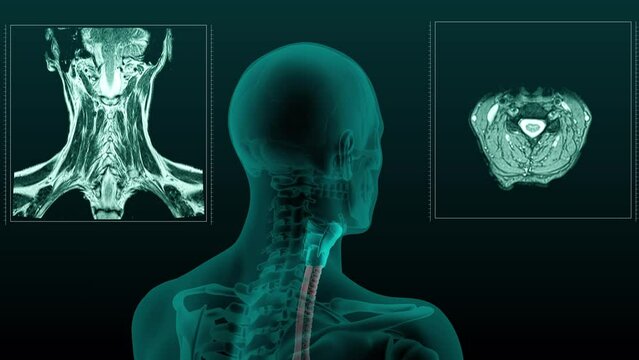 MRI scan of the human head and neck with the trachea visible. 3d render animation of rotation.
