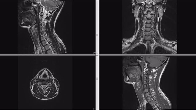 MRI scans of the cervical spine human body. Examining and identifying health problems with magnetic resonance imaging
