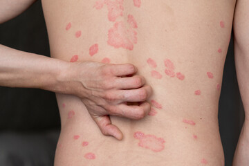 Psoriasis Vulgaris, skin patches are typically red, itchy, and scaly. Papules of chronic psoriasis...
