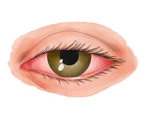 Ojo rojo con conjuntivitis estilo acuarela 
