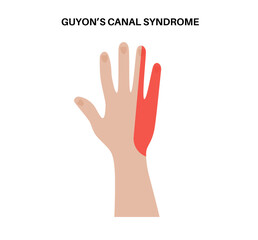 Guyons canal syndrome
