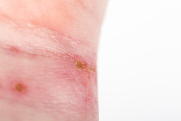 chemical burn on the wrist skin with hydroxide sodium acid, by striping paint from wood furniture. Household accident, because of gloves to sharp