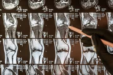 Knee joint x-ray or MRI. Doctor pointed on area of knee joint, where pathology or problem is detected, such fracture, destruction of joint, osteoarthritis.