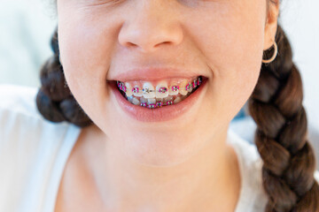Fototapeta premium Close-up of smiling young woman with braces on white teeth. Concept of orthodontic, dental care and malocclusion