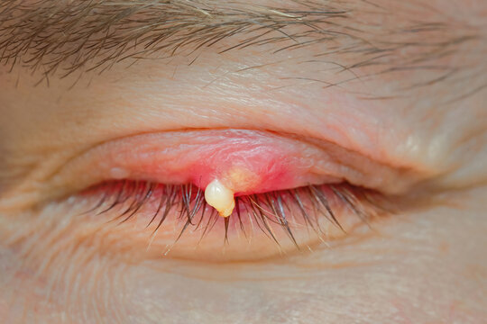 Burst abscess with pus on eyelid. Eye diseas with swollen, inflamed eyelid. Chalazion on upper eyelid close up. Chalazion on eyelid. Demodicosis mite disease, demodex. Selective focus