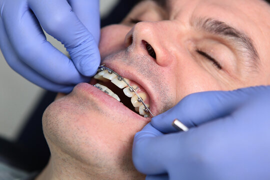Orthodontic treatment. A man with braces on his teeth at an orthodontist's appointment. Alignment of the dentition.