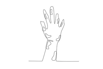 A hand affected by leprosy. World Leprosy Day one-line drawing