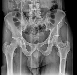 High-quality X-ray of the pelvis, showcasing pelvic bones and reproductive structures. Valuable for obstetrics, gynecology, and orthopedic publications.