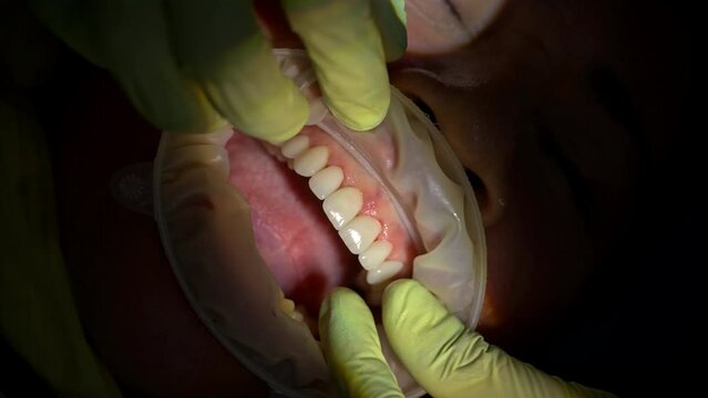 Slow motion vertical shot of a dentist wearing green latex gloves placing a ceramic composite veneer on a patient's canine tooth