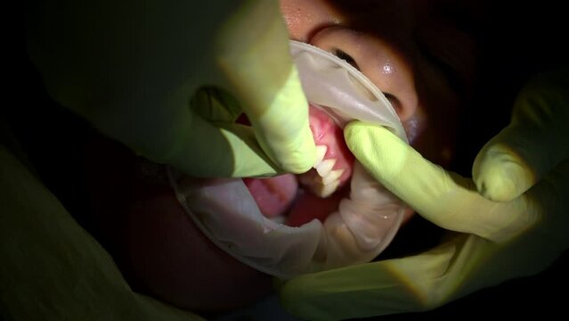 Slow motion shot of a dentist wearing green latex gloves checking the fit of a ceramic composite veneer on a patient's incisor tooth before final collocation