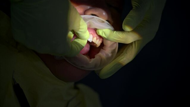 Slow motion shot of a dentist wearing green latex gloves collocating a pair of ceramic composite veneers on a patient's teeth checking the fit