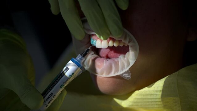 Slow motion shot of a dentist applying a blue gel with acid on top of the patient's teeth to prepare them for the veneer collocation