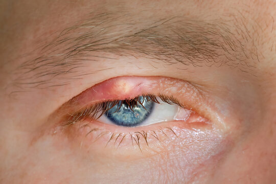 Chalazion, slow-growing lump or cyst that develops within the eyelid. Burst abscess, inflamed area of the eyelid. Eye diseas with swollen, inflamed eyelid. Chalazion on upper eyelid closeup.