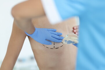 Doctor holding implant in front of patient with preoperative markings on breast closeup. Mammoplasty concept