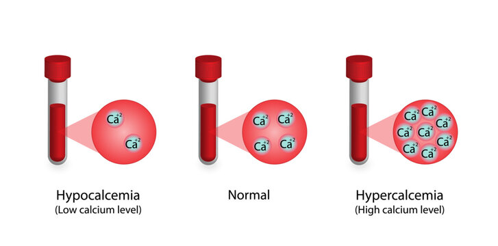 Hypercalcemia, high plasma calcium level and hypocalcemia, low plasma calcium level. Calcium excess and deficit electrolyte disorders, blood droplet, Scientific design. Vector illustration.